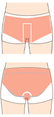 VIO脱毛イラスト