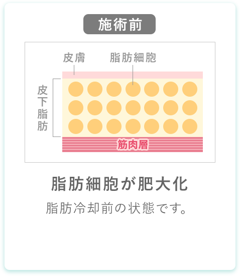 脂肪細胞が肥大化