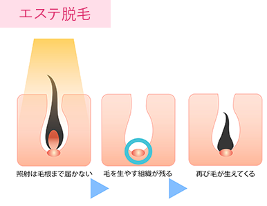 エステ脱毛