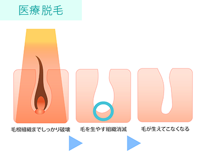 医療脱毛